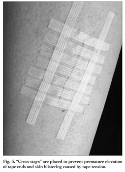 The fine points of taping - Document - Gale Academic OneFile