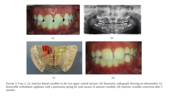 Quality Of Life Following Early Orthodontic Therapy For Anterior Crossbite Report Of Cases In Twin Boys Document Gale Onefile Health And Medicine