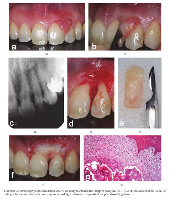 peripheres ossifizierendes Fibrom