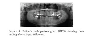 Glandular Odontogenic Cyst in Dentigerous Relationship: An Uncommon Case  Report - Document - Gale OneFile: Health and Medicine