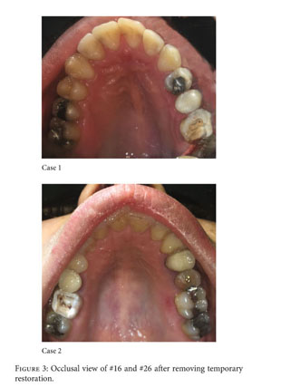 Restoration of a Nonvital Tooth with Fiber Reinforce Composite