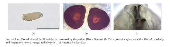 Nasal Myiasis: Case Report and Literature Review