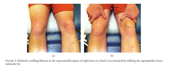 Morel Lavallee Lesion of the Knee in a Recreational Frisbee Player