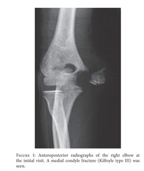 fishtail deformity lateral condyle fracture