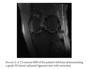 Medial collateral ligament sprain rehabilitation exercises - Document -  Gale OneFile: Health and Medicine