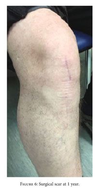 Bursectomy knee complications