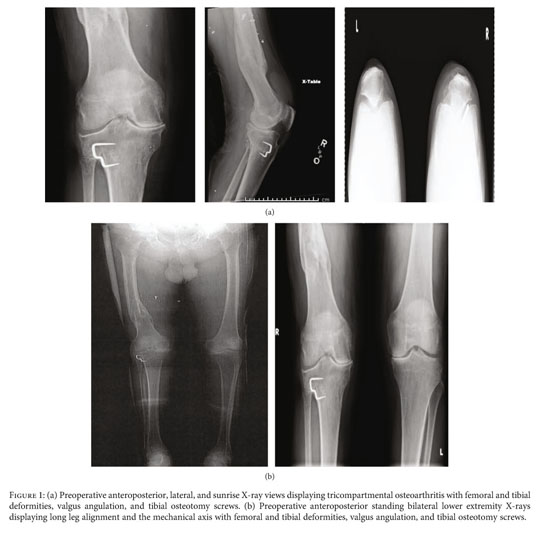 Preoperative long-leg alignment and sample X-rays
