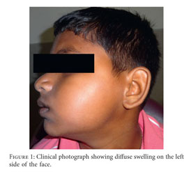 Clinical photograph showing the swelling in the mandibu