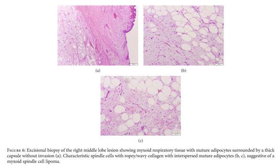 spindle cells and ropey collagen- found in spindle cell lipomas