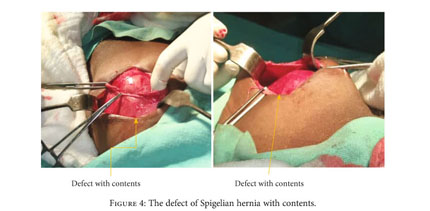 The location of Spigelian fascia and “Spigelian belt” (The image