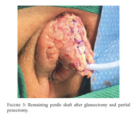 Glansectomy Pics