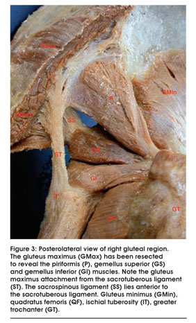 Posterolateral view of right gluteal region. The gluteus maximus