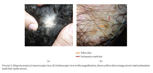 Different trichoscopic features of tinea capitis and alopecia areata in  pediatric patients - Document - Gale OneFile: Health and Medicine