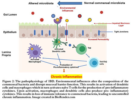 Ulcerative colitis  Nature Reviews Disease Primers