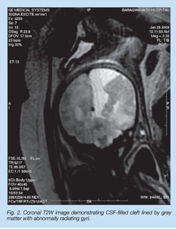 Gale Academic Onefile Document Schizencephaly On Fetal Mri