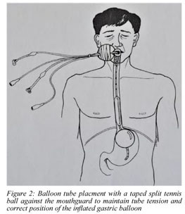 esophagogastric balloon tamponade