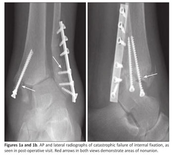 Hindfoot Fusion Nail with Adjuvant Hybrid External Fixation used as  Limb-Salvage Procedure after Failed Open Reduction Internal Fixation of Ankle  Fracture in a Charcot Joint: A Case Report. - Document - Gale