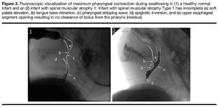 Bell-shaped chest resulting from insufficient intercostal muscle