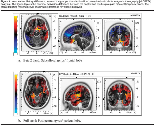 Sensory And Cognitive Components Of Auditory Processing In Individuals With Tinnitus Document Gale Academic Onefile