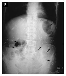 Subcutaneous cysticercosis - Document - Gale Academic OneFile