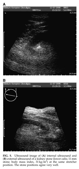 Gale Academic Onefile Document Ultrasound Monitoring Of Kidney Stone Extracorporeal Shockwave Lithotripsy With An External Transducer Does Fatty Tissue Cause Image Distortions That Affect Stone Comminution