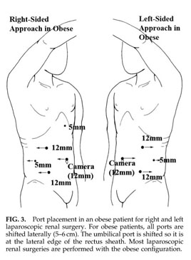 Transperitoneal and Retroperitoneal Port Placement