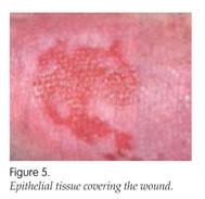 epithelial tissue wound
