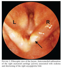 arytenoid cartilage intubation