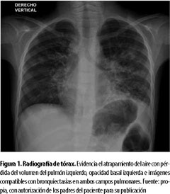 Radiografía de tórax en un paciente con enfermedad de Niemann Pick