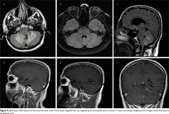 Two New Cases And Literature Review Of Clippers Syndrome With Long Term Follow Up Document Gale Onefile Health And Medicine