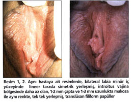 vestibular papillomatosis neden olur tratamentul pielii cu veruci genitale