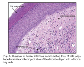 lichen sclerosis histology