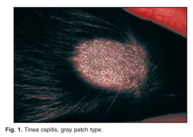 Adult Inflammatory Tinea Capitis Presenting as Diffuse Pustular Type