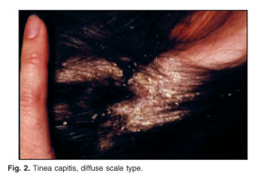 Adult Inflammatory Tinea Capitis Presenting as Diffuse Pustular Type