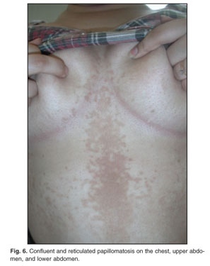 Confluent and reticulated papillomatosis and acanthosis nigricans