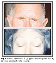 Primary blepharospasm: diagnosis and management. - Document - Gale OneFile:  Health and Medicine