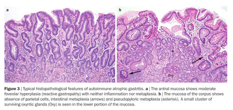 atrophic gastritis histology