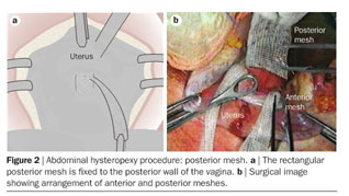 A Case of Laparoscopic Sacrohysteropexy: A Uterus Preserving Surgical  Procedure for the Treatment of Uterine Prolapse
