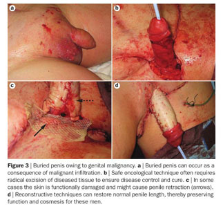 Therapeutic strategies for patients with micropenis or penile dysmorphic  disorder - Document - Gale Academic OneFile