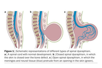 Urinary considerations for adult patients with spinal dysraphism