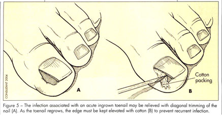 Ingrown toenails: office procedures to treat acute and chronic  problems--steps to prevent recurrence - Document - Gale Academic OneFile
