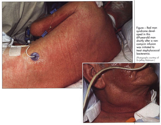 Erythematous rash in man receiving infusion - Document - Gale Academic OneFile
