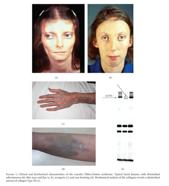 Hereditary Connective Tissue Diseases In Young Adult Stroke A Comprehensive Synthesis Document Gale Onefile Health And Medicine