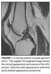 Medial collateral ligament sprain rehabilitation exercises - Document -  Gale OneFile: Health and Medicine