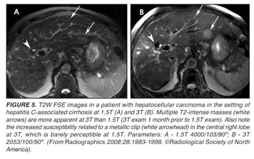 Hyperecho-Turbo Spin-Echo Sequences at 3T: Clinical Application in  Neuroradiology