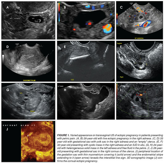 Imaging evaluation of acute pelvic pain in the emergency 