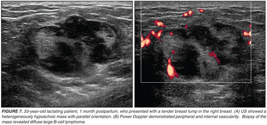 Breast disease in the pregnant and lactating patient: radiological