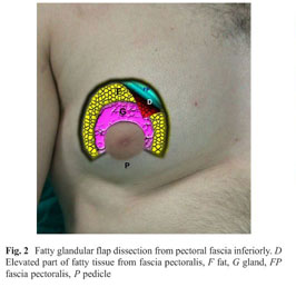 An ameliorated approach for sharp resection in gynecomastia