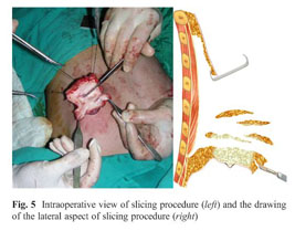 Breast reduction in gynecomastia