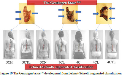 SCOLIOSIS THERAPY, A LINK BETWEEN THE SCHROTH-3D SCOLIOSIS PROGRAMAND THE GENSINGEN  BRACE. - Document - Gale Academic OneFile